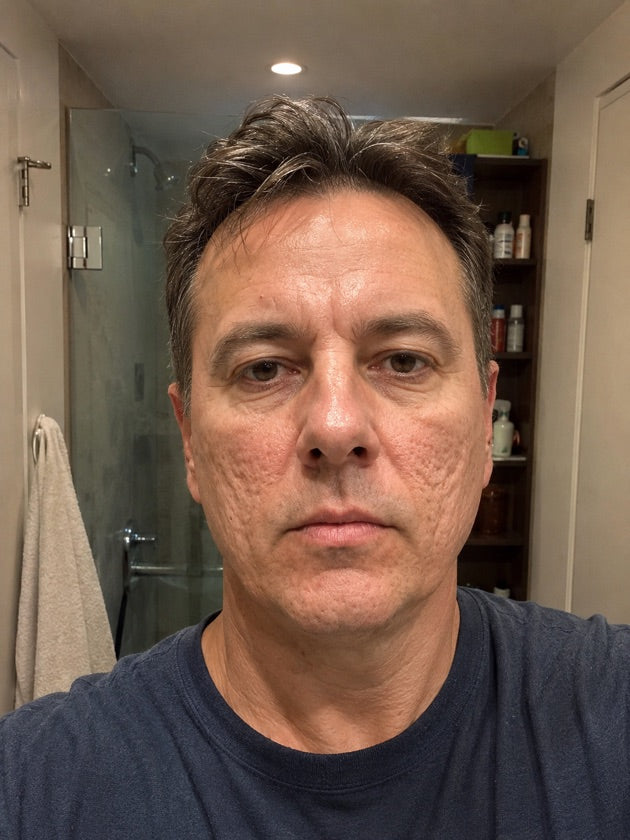 José antes de Astroderma — cicatrices y textura profunda de acné