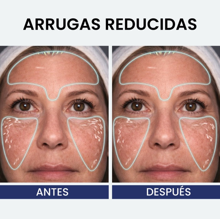 Antes y después — arrugas reducidas