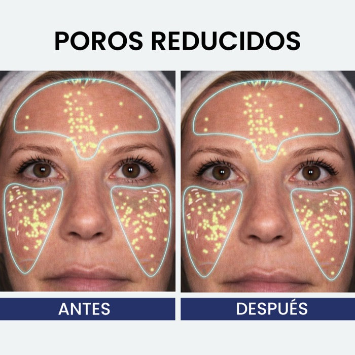 Antes y después — poros reducidos