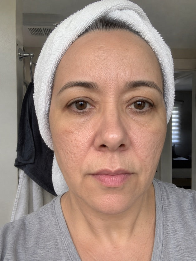 Adriana antes de Astroderma — cicatrices de acné y textura marcada