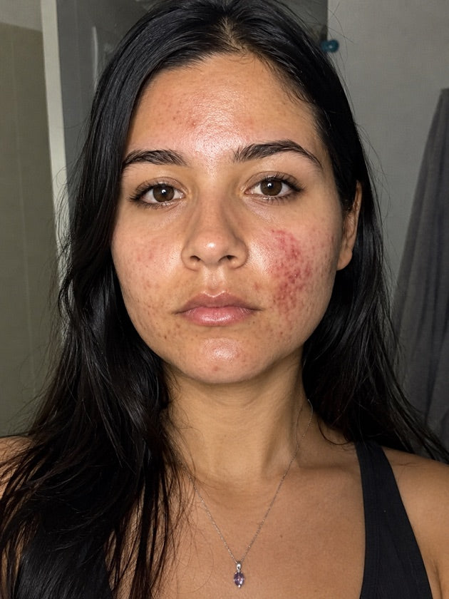 Inés antes de Astroderma — acné activo y rojez en mejillas